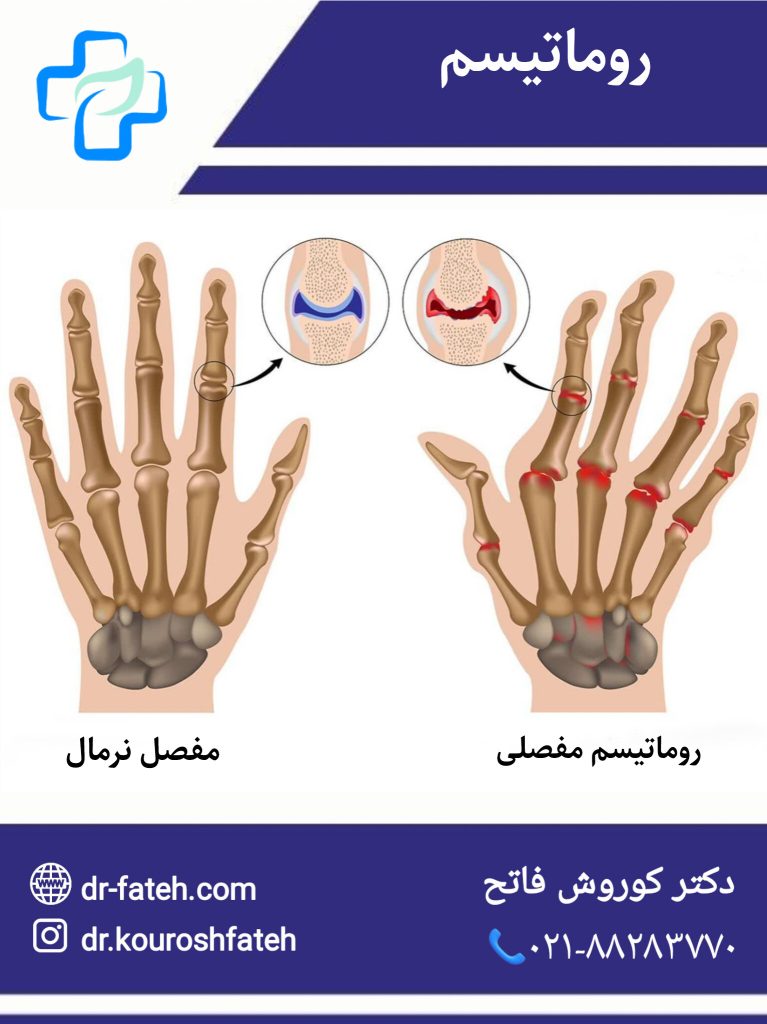 روماتیسم