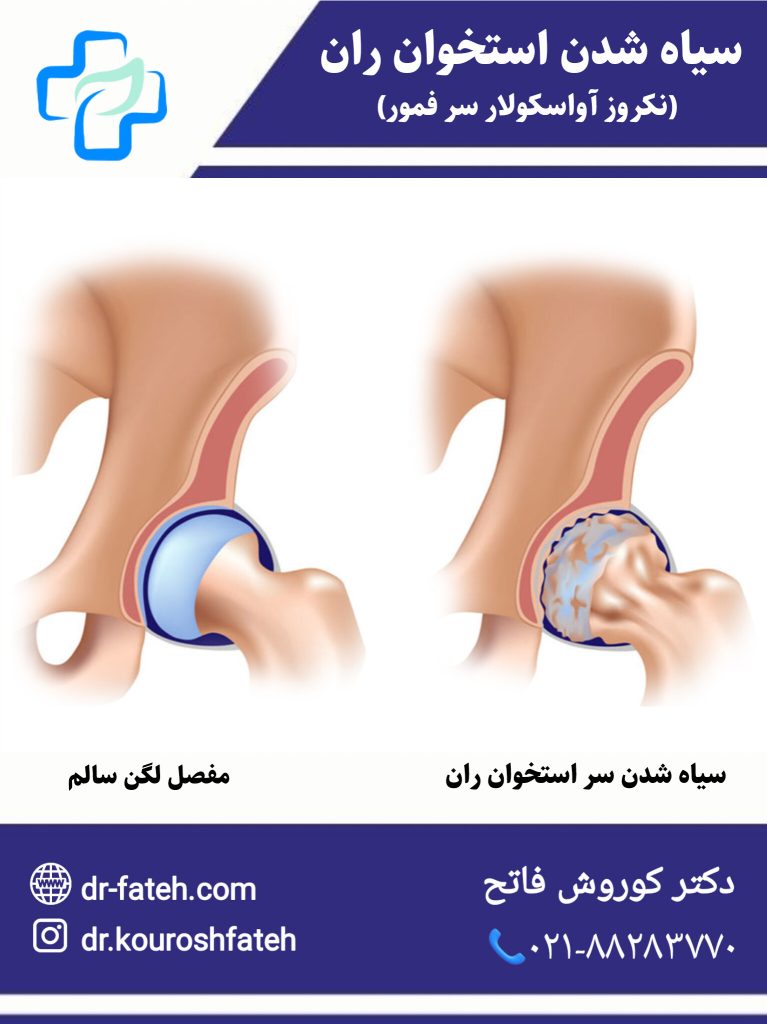 سیاه شدن استخوان ران