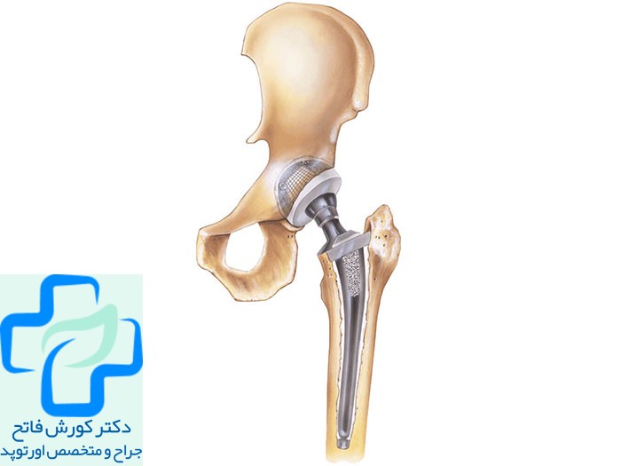 تعویض مفص ران