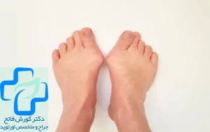 انحراف انگشت پا