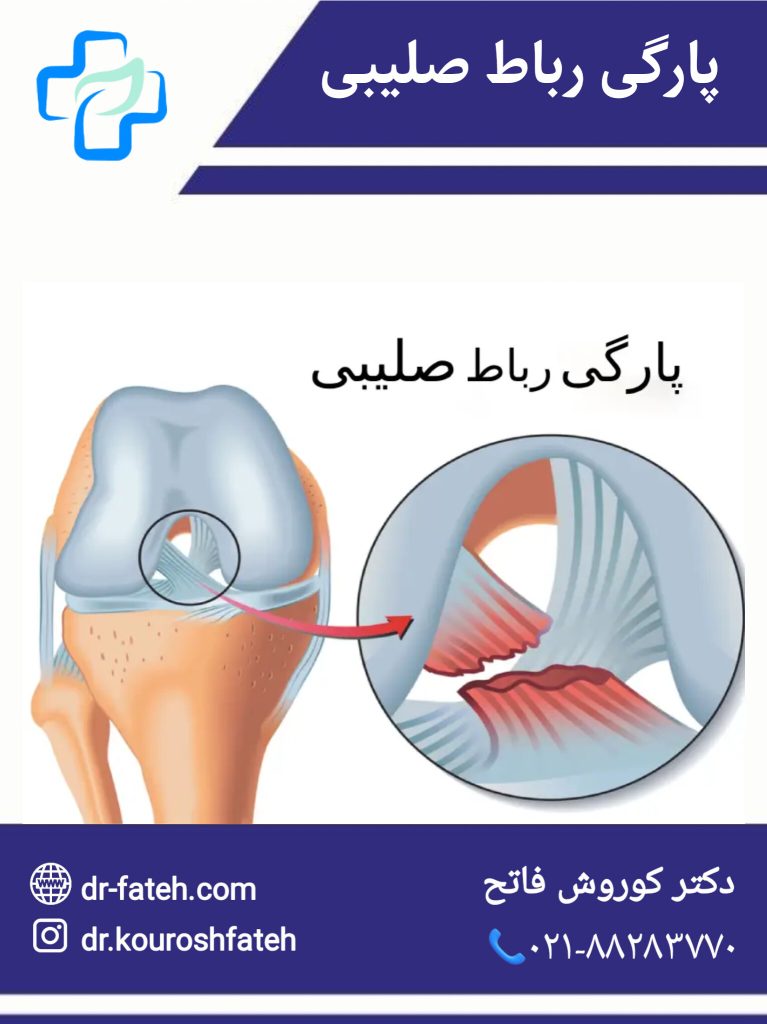 پارگی رباط صلیبی