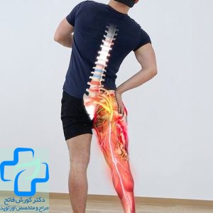 سیاتیک چیست
