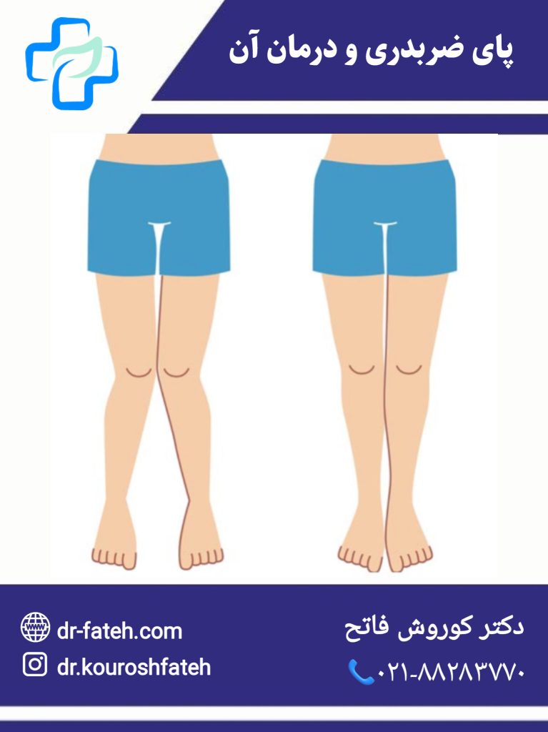 پای ضربدری و درمان آن