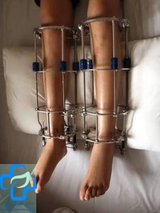 جراحی افزایش قد