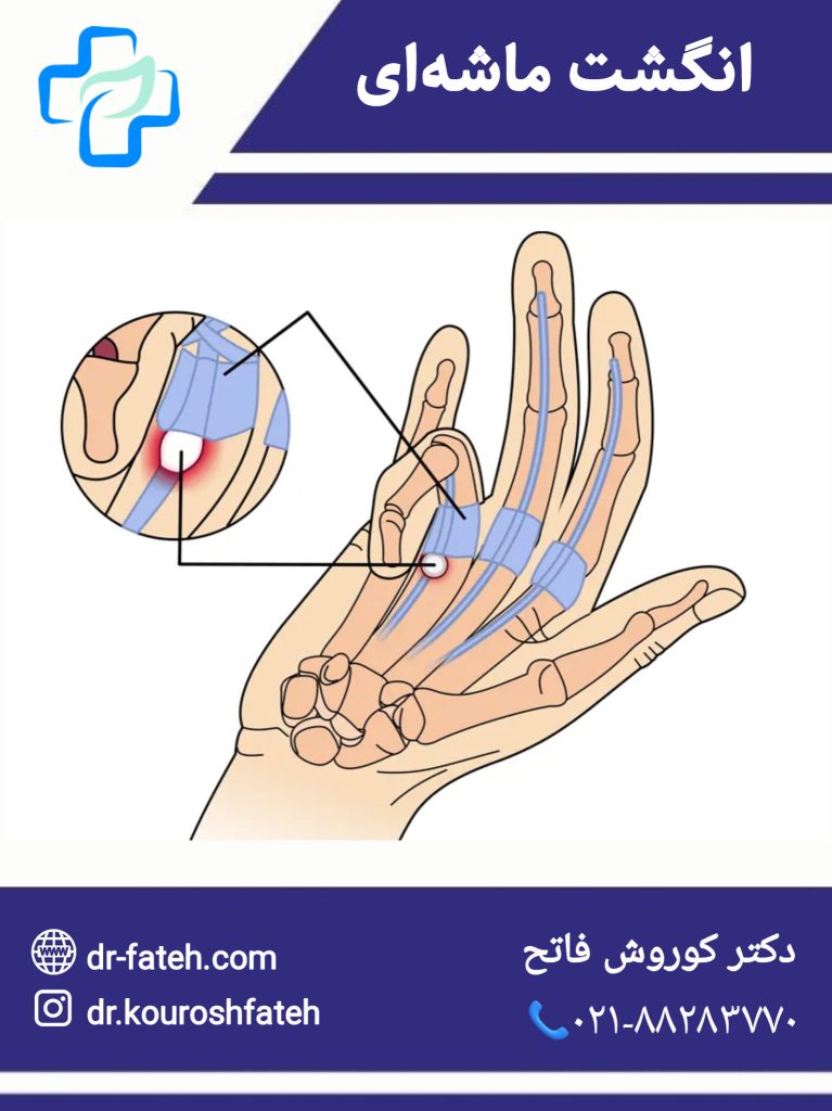 بیماری انگشت ماشه ای