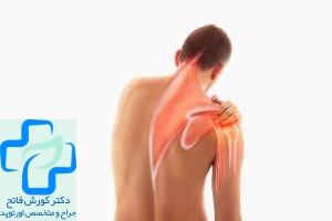 پارگی تاندون شانه