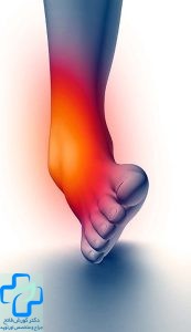 پیچ خوردگی مفاصل