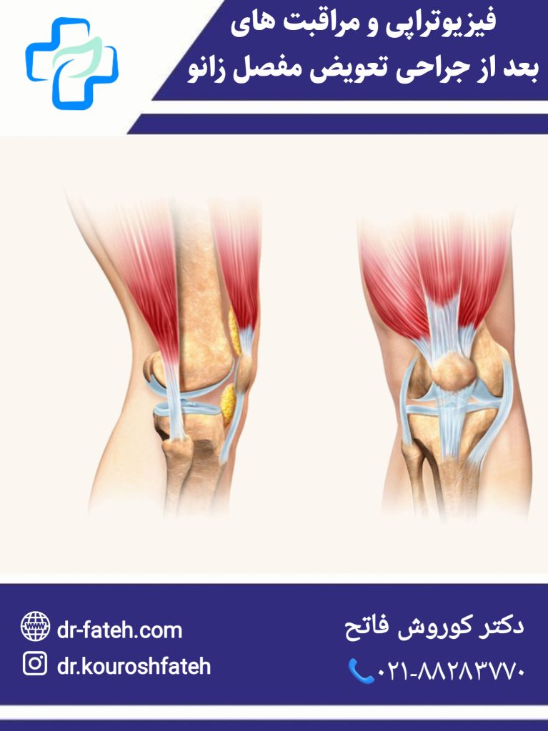 فیزیوتراپی بعد از جراحی مفصل زانو
