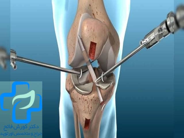 سوالات پرتکرار بیماران بعد از انجام جراحی زانو
